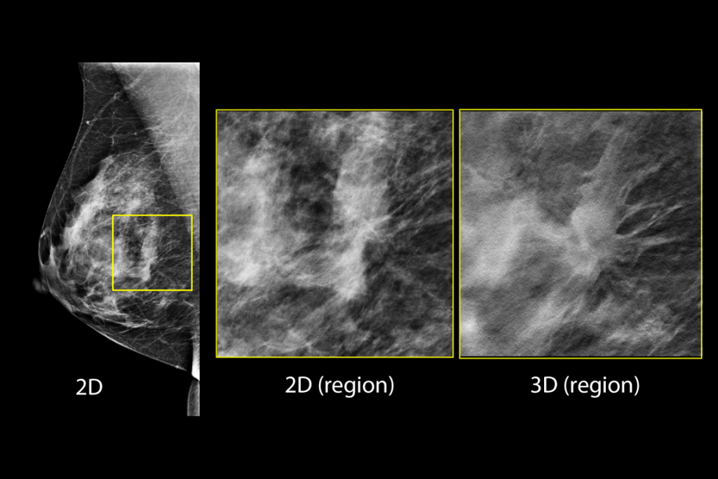 Clinical images of breast scan with suspicious Lesion