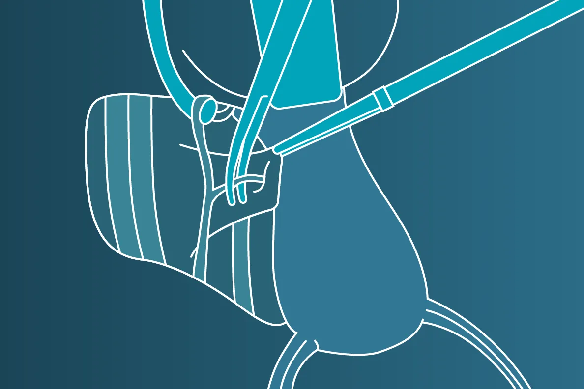 Linework illustration representing gyn surgical solutions vessel sealing