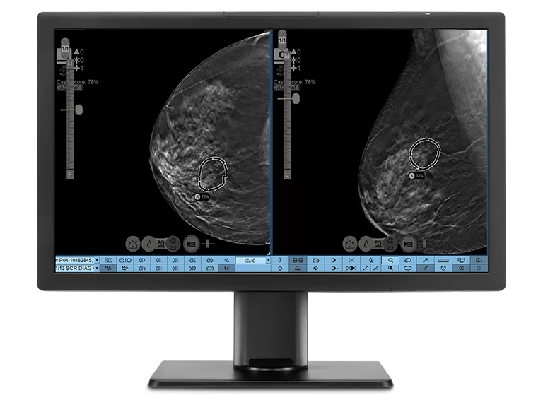 A computer monitor showing breast scan images